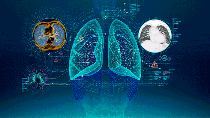 AI diagnosis for lung tumor