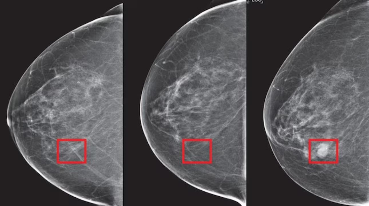breast cancer lumps